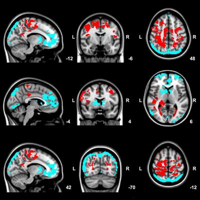 Altered Whole-Brain and Network-Based Functional Connectivity in Parkinson's Disease